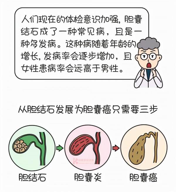 膽囊癌：細聽六個“危險警報”