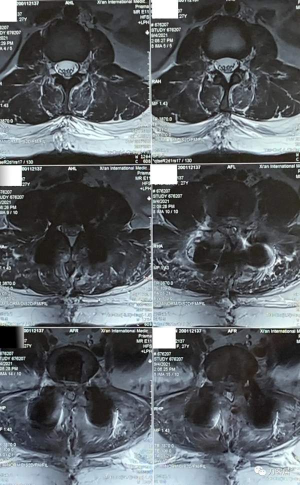 27歲女性，兩間隙腰椎間盤突出症，6顆釘子，4個融合器