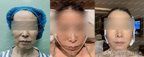 面部開始鬆弛下垂衰老的三大訊號，一定要開始注意了