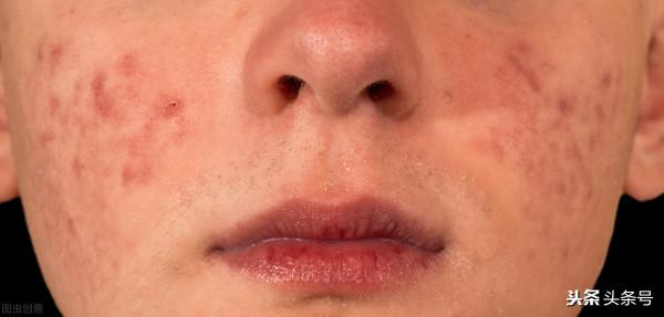 面板凹凸不平，痘痘留下的痘印太難去，怎麼辦？