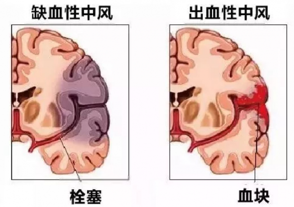 高血壓是“中風”的禍根,提醒:4個表現,多半中風已找上門 高血壓是“中風”的禍根,提醒:4個表現,多半中風已找上門