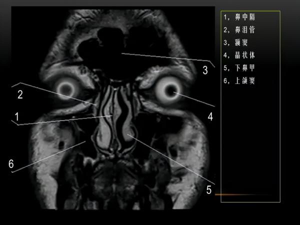 MRI下眼部及鼻竇解剖