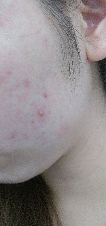 痤瘡是內分泌失調嗎？