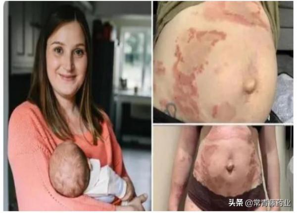 萬萬沒想到，媽媽還會對自己的孩子過敏？醫生：是妊娠性類天皰瘡
