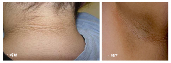 身上的這些地方為什麼會變黑？還能不能白回來了？