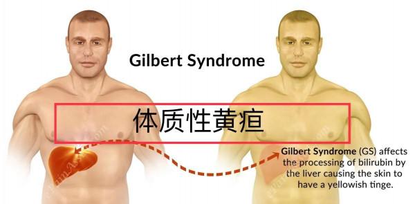 肝功能單純膽紅素升高,吃了很多藥都沒有效果?醫生給你分析病因 肝功能單純膽紅素升高,吃了很多藥都沒有效果?醫生給你分析病因
