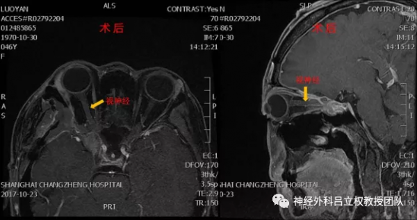 罕見腫瘤從眼眶長到顱內，怎麼辦？