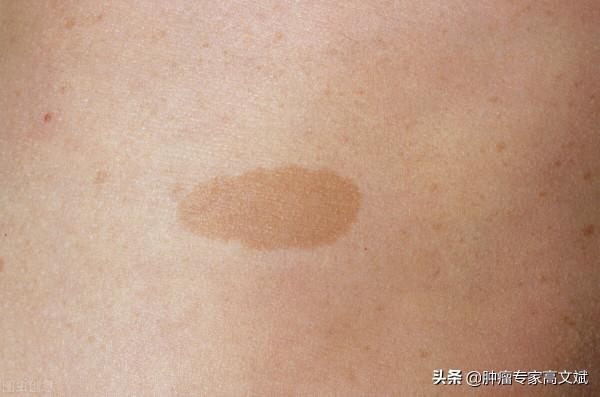 “牛奶斑”“泡泡寶貝”這些可能都是腫瘤的表現