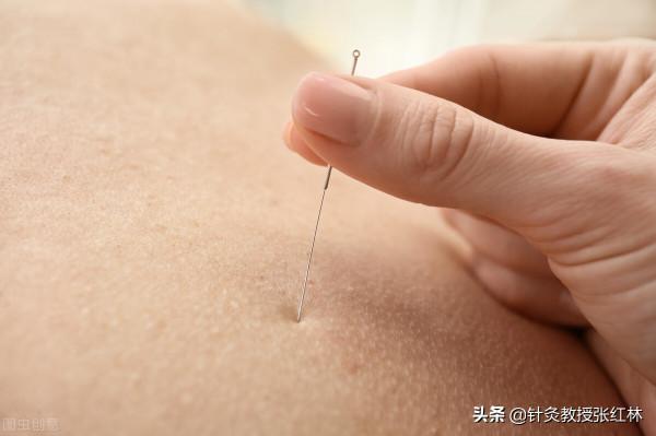 嗓子異物感，咽不下咳不出，這叫梅核氣。針灸怎樣治？