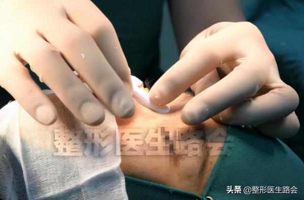 做假體隆鼻,整形醫生告訴你:術前、術中、術後,如何少走彎路 做假體隆鼻,整形醫生告訴你:術前、術中、術後,如何少走彎路
