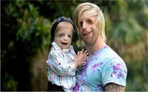 英國男子臉部畸形，憑魅力迎娶美女大學生，孩子出生後笑不出來了