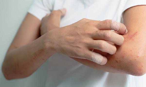 冬季面板持續瘙癢，可能是特應性皮炎