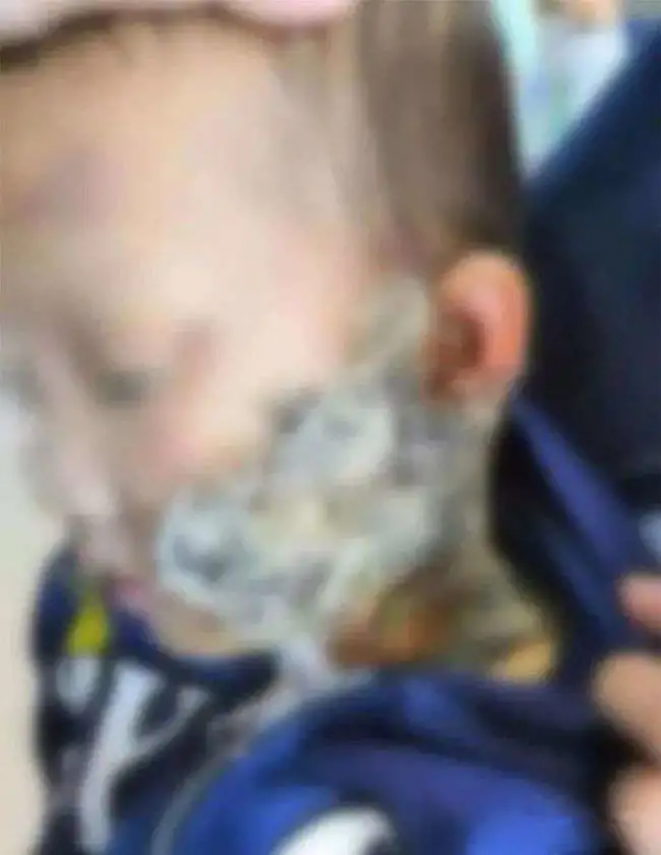 10個月女嬰，被家人刮痧毀了臉