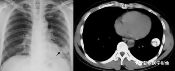 肺部5大基本病變,影像診斷的基礎 肺部5大基本病變,影像診斷的基礎