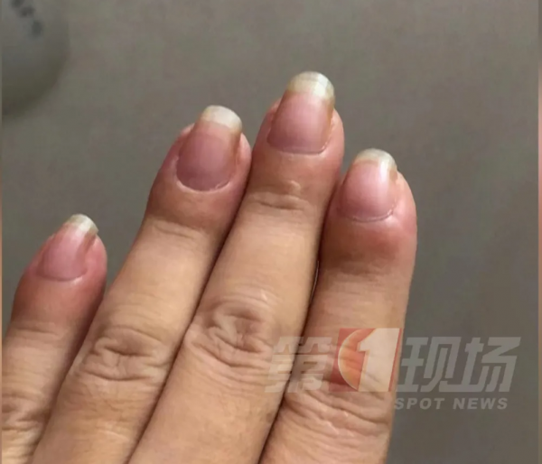 手指腫大竟查出肺癌?手的這些異樣,可能是大病警告 手指腫大竟查出肺癌?手的這些異樣,可能是大病警告