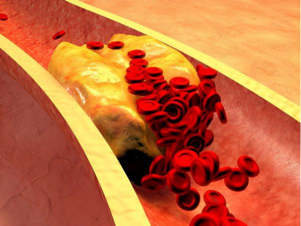 冠心病患者服用這5類藥物，可有效預防心梗，改善預後