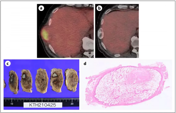 消失的病灶，奧希替尼單藥治療晚期肺癌達到病理完全緩解