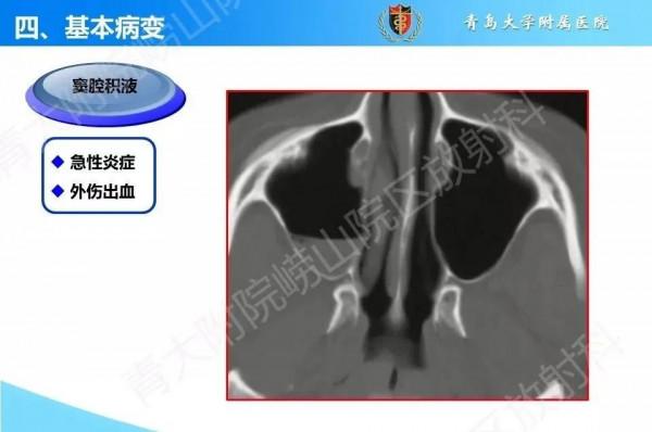 頭頸五官CT斷層解剖圖及常見病影像診斷