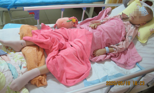 顱內生殖細胞瘤切除術後腦積水仍反覆,意識模糊,左側肢體偏癱 顱內生殖細胞瘤切除術後腦積水仍反覆,意識模糊,左側肢體偏癱