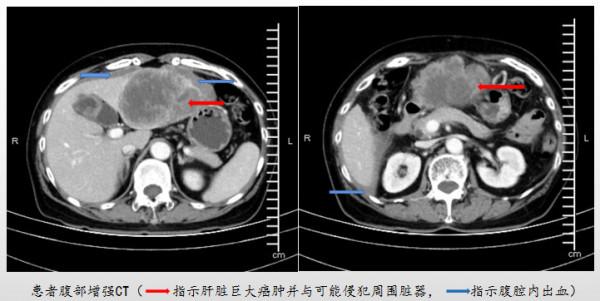 巨大肝癌破裂出血命懸一線, 居然和十五年前肝炎有關係 巨大肝癌破裂出血命懸一線, 居然和十五年前肝炎有關係