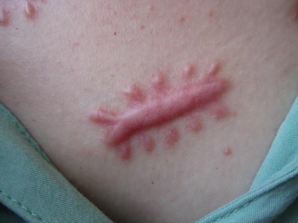 凸起的疤痕幾年能變平整? 凸起的疤痕幾年能變平整?