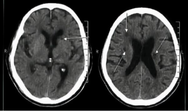 得了腔隙性腦梗塞，會不會偏癱，要不要把血管疏通一下？