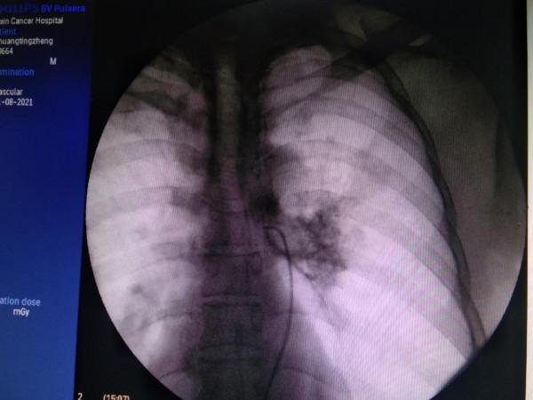 「病例分享」53歲肺鱗癌患者，出現咯血，兩週期治療後腫瘤消失