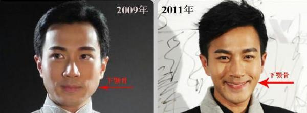 男星也微整？打玻尿酸、填充脂肪，有多少人假面且同化