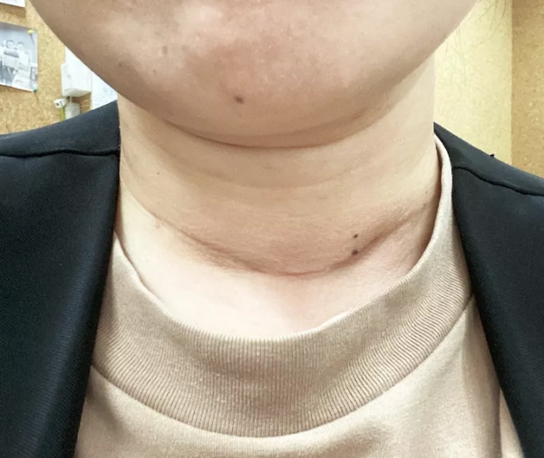 甲友心聲——甲狀腺癌，其實沒有你想的那麼可怕