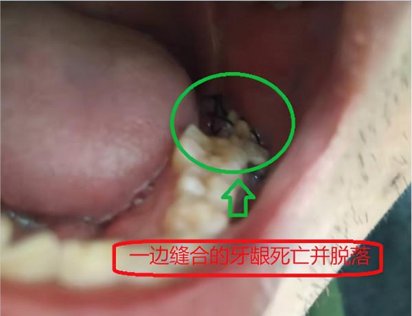 這算不算種植牙醫療事故? 這算不算種植牙醫療事故?