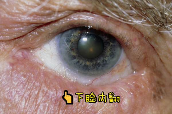 教你幾招認識一下常見的眼瞼位置異常