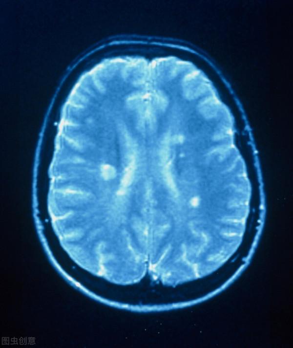 多發性硬化是個什麼鬼？中醫可以治療嗎？