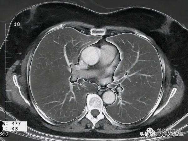 CT斷層解剖圖譜最全總結「推薦收藏」 CT斷層解剖圖譜最全總結「推薦收藏」