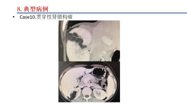 南昌大學二附院泌尿外科江偉凡博士分享腹腔鏡腎部分切除術治療複雜腎腫瘤的新進展及疑難病例