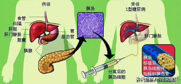 治癒糖尿病的新手段——胰島移植 治癒糖尿病的新手段——胰島移植