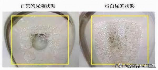 有泡沫尿就是腎臟有問題嗎? 有泡沫尿就是腎臟有問題嗎?