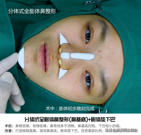 做假體隆鼻,整形醫生告訴你:術前、術中、術後,如何少走彎路 做假體隆鼻,整形醫生告訴你:術前、術中、術後,如何少走彎路