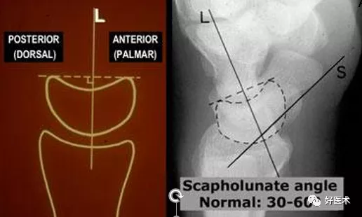 贊！腕關節X線高畫質解剖+腕骨脫位典型病例