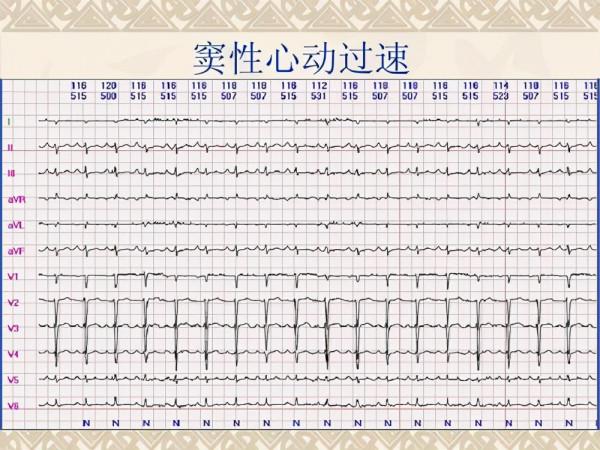 心臟1分鐘跳多少次算心動過速?心動過速,應該如何治療? 心臟1分鐘跳多少次算心動過速?心動過速,應該如何治療?