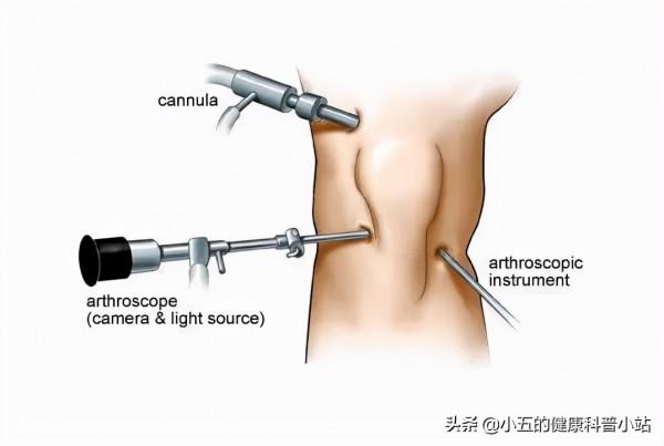 膝關節咔咔作響,上下樓疼痛不適,髕骨軟化症到底該如何治療 膝關節咔咔作響,上下樓疼痛不適,髕骨軟化症到底該如何治療