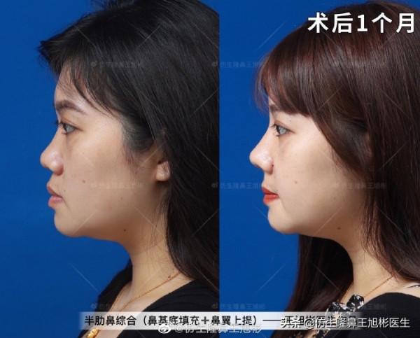 鼻基底填充後,為什麼會變成“猴子”?原來是裡沒有處理好 鼻基底填充後,為什麼會變成“猴子”?原來是裡沒有處理好