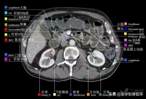 CT斷層解剖圖譜最全總結「推薦收藏」 CT斷層解剖圖譜最全總結「推薦收藏」