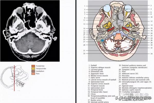 CT斷層解剖圖譜最全總結「推薦收藏」 CT斷層解剖圖譜最全總結「推薦收藏」
