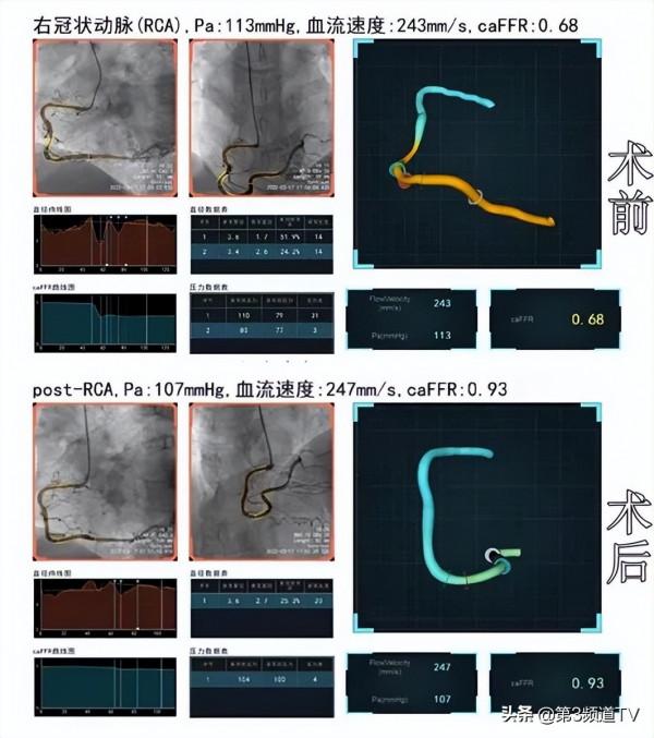 心臟要不要放支架？它“說”了算