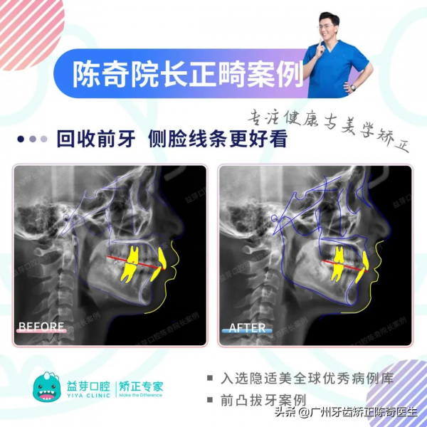 全球優秀案例 | 隱適美拔牙矯正1年半時間解除牙列間隙、改善嘴凸 全球優秀案例 | 隱適美拔牙矯正1年半時間解除牙列間隙、改善嘴凸