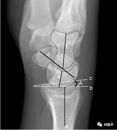 贊！腕關節X線高畫質解剖+腕骨脫位典型病例