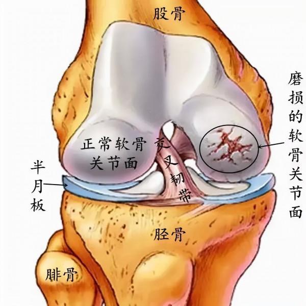 膝蓋說:“炎”重警告!且行且珍惜 膝蓋說:“炎”重警告!且行且珍惜