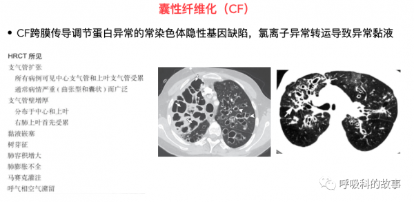 反覆發作鼻竇炎、咳嗽、支氣管擴張,這個病我們要提高認識 反覆發作鼻竇炎、咳嗽、支氣管擴張,這個病我們要提高認識