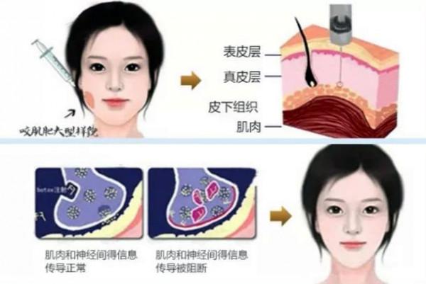 我打瘦臉針“差不多有10年”了,分享真實經驗 我打瘦臉針“差不多有10年”了,分享真實經驗
