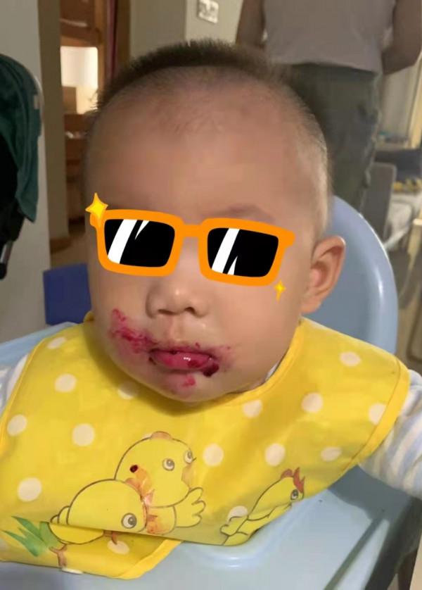 寶寶是一隻“小兔子”，還沒長牙就要開始正畸了